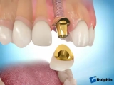 Implantátum videó