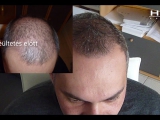 L. Zoltán hajbeültetési eredménye a HIMG Klinikán