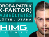 Zdroba Patrik (X-FAKTOR) Hajbeültetése - HIMG...