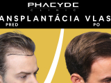 Transplantácie vlasov metódy - PHAEYDE Clinic