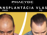 Postupy pri transplantácii vlasov - PHAEYDE Clinic