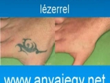 Tetoválás eltávolítás