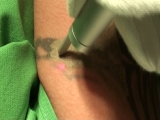 Tetoválás eltüntetése lézerrel - www.anyajegy.net