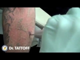 Lézeres tetováláseltávolító