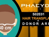 Hair Transplant and Donor Area - PHAEYDE...
