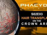 Hair Transplant on the Crown Area - PHAEYDE...