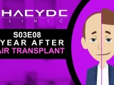 1 Year After Hair Transplant - PHAEYDE Clinic...