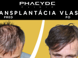 Transplantácia vlasov - PHAEYDE Clinic
