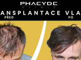 Transplantace vlas Pred/Po - PHAEYDE Clinic