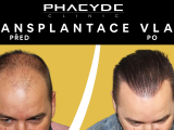 Postupy pri transplantaci vlasu - PHAEYDE Clinic