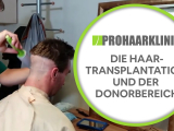 Die Haartransplantation und der Donorbereich -...