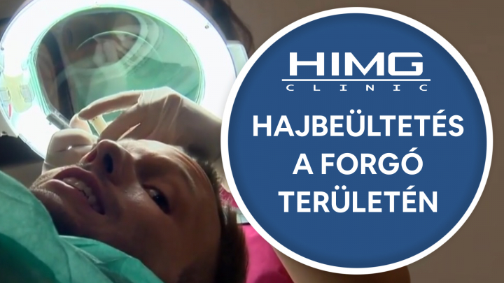 Hajbeültetés a forgó területén - HIMG Hajbeültetés Klinika