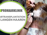 Haartransplantation Bei Langen Haaren -...