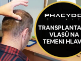 Transplantace vlasu na temeni hlavy - PHAEYDE...