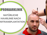 Natürliche Haarlinie nach Haartransplantation...