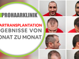 Haartransplantation ergebnisse von Monat zu...