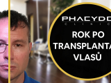Rok po transplantaci vlasu - PHAEYDE Clinic