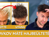 Hajbeültetés után: Novkov Máté - HIMG...